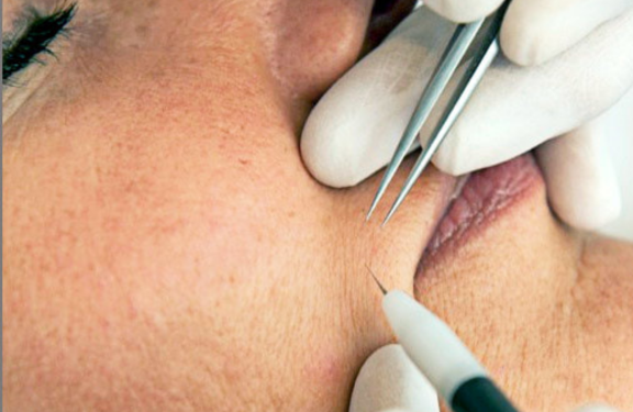 Tri for electrolysis